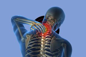 Symptomer vun der Gebärmutterhals Osteochendrosis