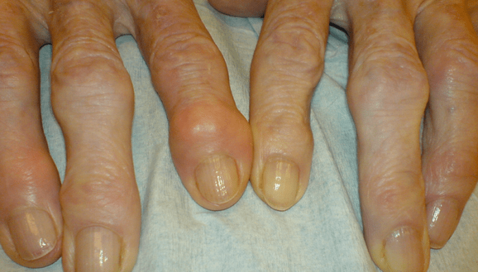 Péng an de Gelenker vun de Fanger mat Osteoarthritis