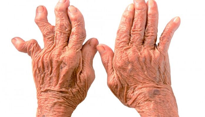 rheumatoid Arthritis als Ursaach vu Schmerz an de Gelenker vun de Fanger