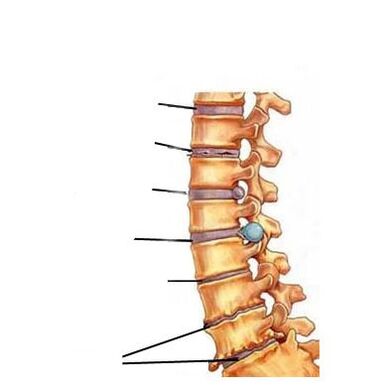 Etappe vun der Entwécklung vun Osteochondrose