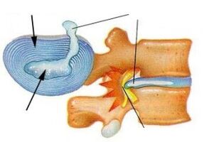 Zerstéierung vum fibrous Ring an der Gebärmutterhals Osteochondrose
