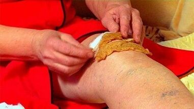 Kompriméiert fir Arthrosis vum Knéi Gelenk