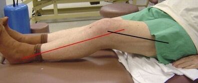 Progressiv Arthrosis vum Knéi Gelenk