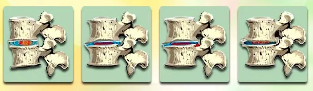 Phasen an der Entwécklung vun der Osteochondrose