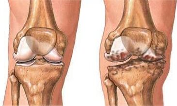Arthrosis vum Knéi