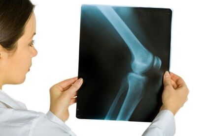 Behandlung vun Arthrosis vum Knéi Gelenk