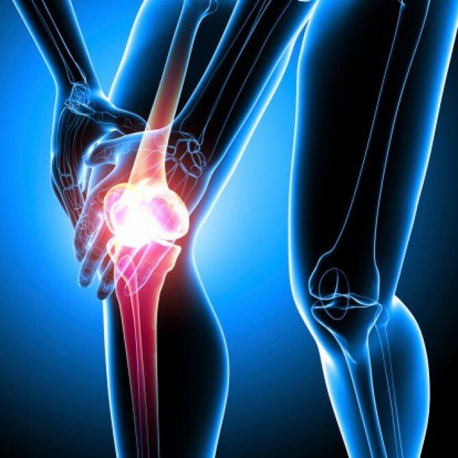 Fortgeschratt Stadium rheumatoid Arthritis kann Hip Schmerz verursaachen