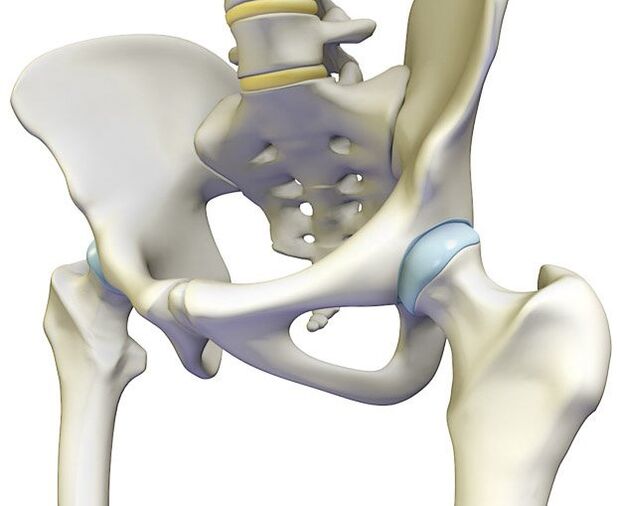 Osteochondrose provozéiert e scharfen Schmerz am Hüftgelenk