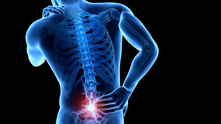 Réckschmerzen mat Lendeger Osteochondrose